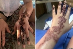 how to get rid of black henna scars, black henna tattoo burns, henna tattoo cause aussie woman to almost lose her hand, Tattoos
