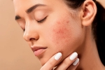 skin, home remedies, 10 ways to get rid of pimples at home, Natural glow