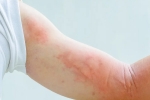 covid-19, covid-19, dermatological symptoms could be a sign for covid 19 infection, Dry cough
