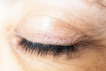 Eyelash Dandruff, Eyelash Dandruff symptoms, all about eyelash dandruff, Conjunctivitis