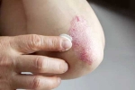 Skin disorders related, Skin disorders tips, five common skin disorders and their symptoms, Immune system