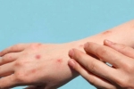 Monkeypox updates, Monkeypox cases, study says that the symptoms of monkeypox are different from earlier, Monkey