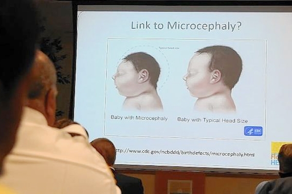 Zika: Birth defect reported in Florida